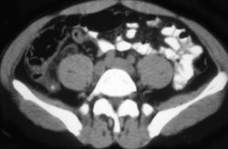 Appendicitis With Stone - CTisus CT Scan