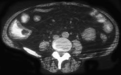 Ischemic Colitis (cecum) - CTisus CT Scan