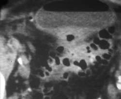 Diverticulitis With Fistulae to the Bladder - CTisus CT Scan