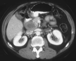 Recurrent Colon Cancer With Portocaval Nodes - CTisus CT Scan