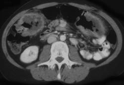 Simultaneous Ulcerating Colon Cancer - CTisus CT Scan