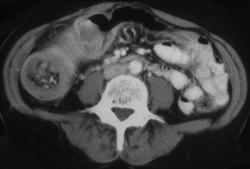 Cecal Cancer With Intussusception - CTisus CT Scan