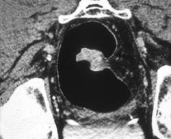 Rectal Cancer With Supine and Prone Views - CTisus CT Scan