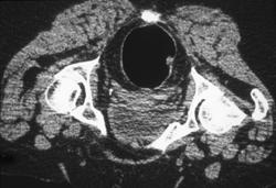 Rectal Cancer - CTisus CT Scan