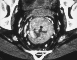 Bulky Rectal Cancer - CTisus CT Scan