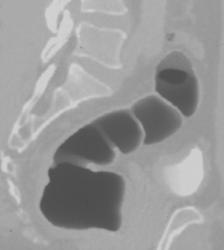 Superficial Rectal Cancer - CTisus CT Scan