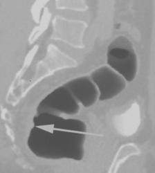 Ulcer in Rectal Cancer - CTisus CT Scan