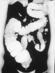 Apple Core Colon Cancer - CTisus CT Scan