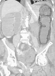 Infarcted Bowel With Hernia of Bowel Into the Scrotum - CTisus CT Scan