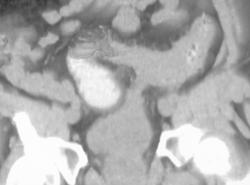 Fistulae From Bladder to the Sigmoid Colon - CTisus CT Scan