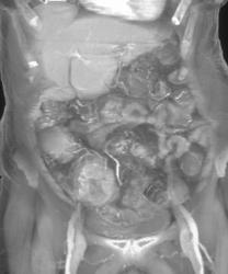 Colon Cancer - CTisus CT Scan