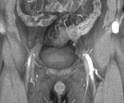 Colon Cancer (infiltrating) - CTisus CT Scan