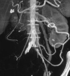 Collaterals Through the IMA in Occluded SMA Patient - CTisus CT Scan