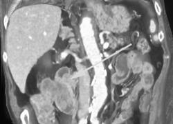 Recurrent Colon Cancer Invades Duodenum - CTisus CT Scan