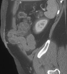 Hernia Near Osteotomy Site - CTisus CT Scan