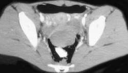 Pneumoperitoneum Due to Perforated Rectum - CTisus CT Scan