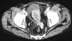 Recurrent Colon Cancer With Small Bowel Obstruction - CTisus CT Scan