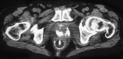 Colo-vaginal Fistulae - CTisus CT Scan