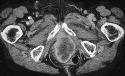 Recurrent Anal Cancer - CTisus CT Scan