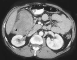 Lymphoma of the Hepatic Flexure - CTisus CT Scan