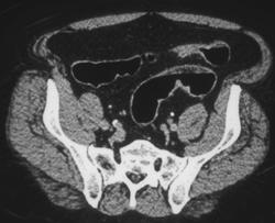 Colon Cancer - CTisus CT Scan