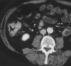 Colon Cancer - CTisus CT Scan