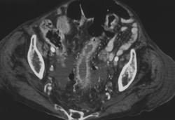 Ischemic Colitis - CTisus CT Scan