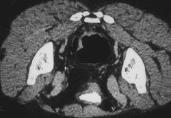 Colon Cancer - CTisus CT Scan