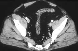 Chronic Ulcerative Colitis - CTisus CT Scan