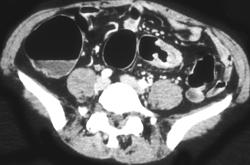 Colon Cancer - CTisus CT Scan