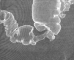 Apple Core Lesion in the Sigmoid Colon - CTisus CT Scan