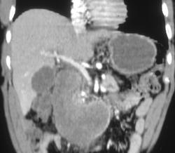 Obstructed Duodenum - CTisus CT Scan