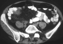 Colon Cancer - CTisus CT Scan