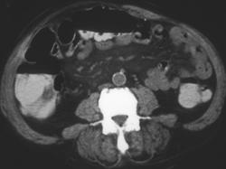 Carcinomatosis - CTisus CT Scan