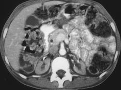 Extensive Stool in Colon in Patient With Renal Failure - CTisus CT Scan