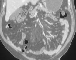 Mesenteric Paniculitis - CTisus CT Scan