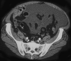 Carcinomatosis - CTisus CT Scan