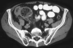 Ischemic Colitis - CTisus CT Scan