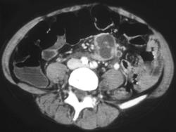 Tuberculosis (TB) Involving Mediastinum and Mesentery - CTisus CT Scan