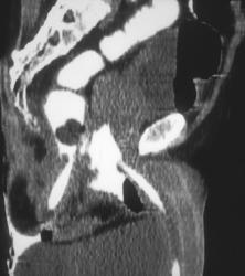 Perforation of the Bladder By Catheter With Catheter Extending Into the Rectum - CTisus CT Scan