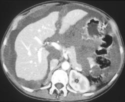 Pseudomyxoma Peritonei (PMP) - CTisus CT Scan