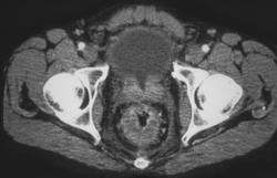 Rectal Cancer - CTisus CT Scan