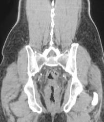 Rectal Cancer - CTisus CT Scan