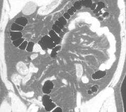 Pseudotumor of the Colon - CTisus CT Scan