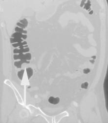 Prominent Ileocecal Valve - CTisus CT Scan