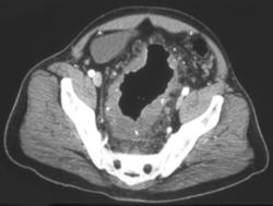 Hemangiomatosis of the Colon and Mesentery - CTisus CT Scan