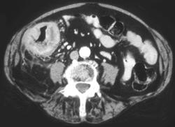 Infiltrating Adenocarcinoma of the Right Colon - CTisus CT Scan