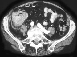 Cecal Cancer Obstructing the Appendix - CTisus CT Scan