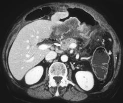 Perforated Transverse Colon With Abscess - CTisus CT Scan