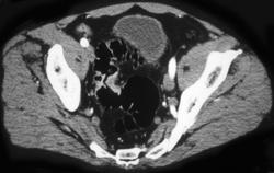 Colon Cancer - CTisus CT Scan